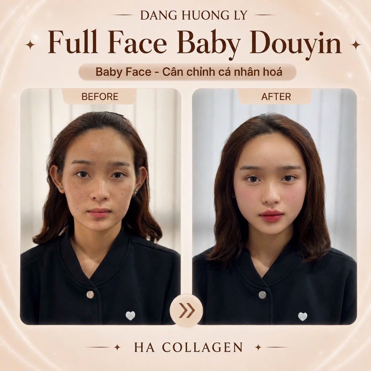Khách hàng trước và sau khi cân chỉnh Full Face Baby Douyin