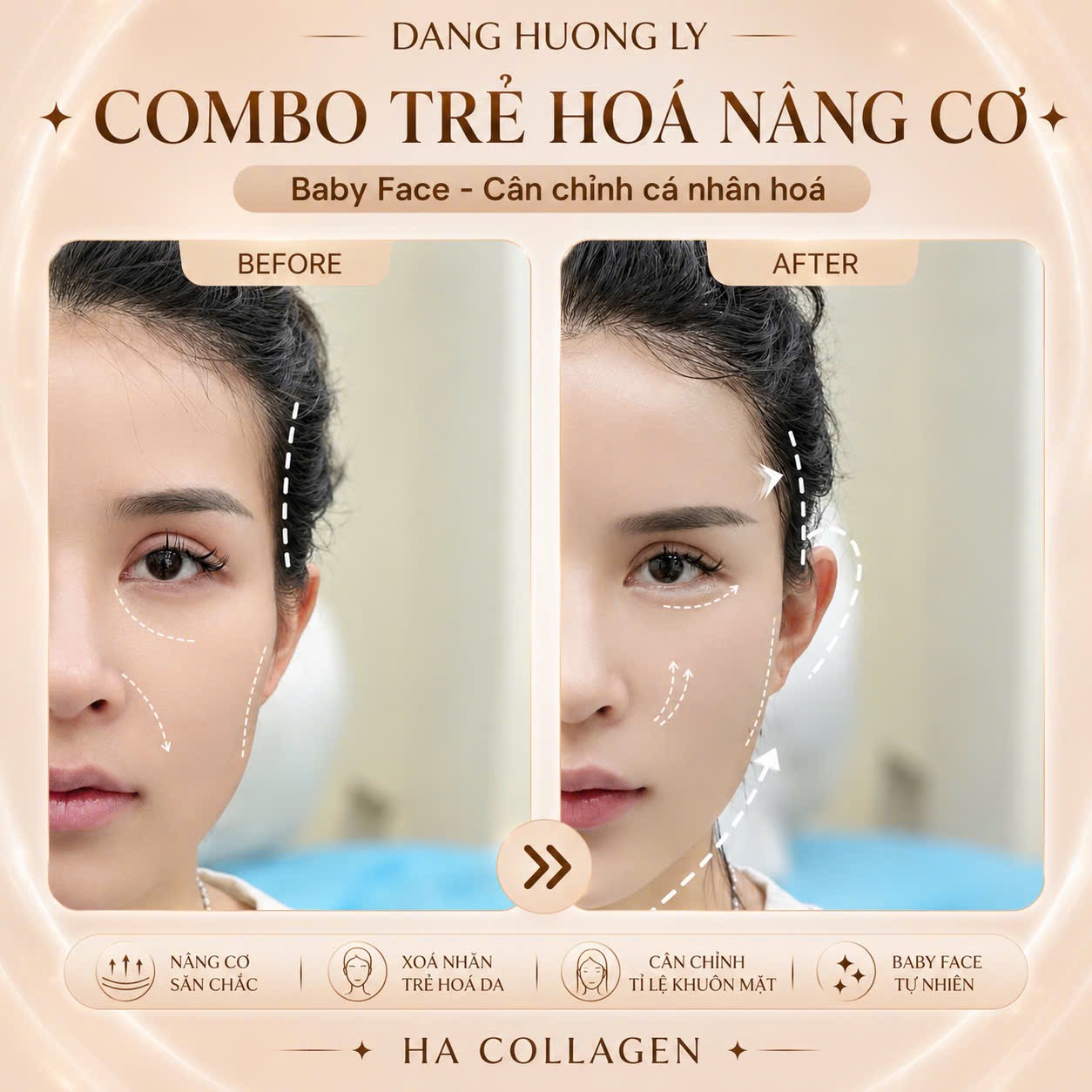 Khách hàng trước và sau khi sử dụng combo trẻ hóa nâng cơ