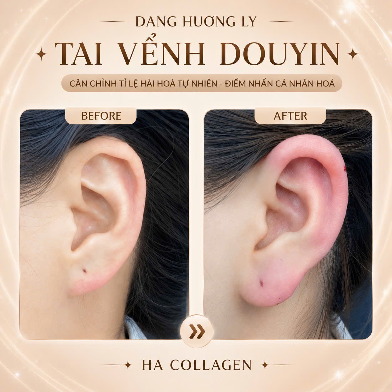 Khách hàng trước và sau khi cân chỉnh tai vểnh Douyin
